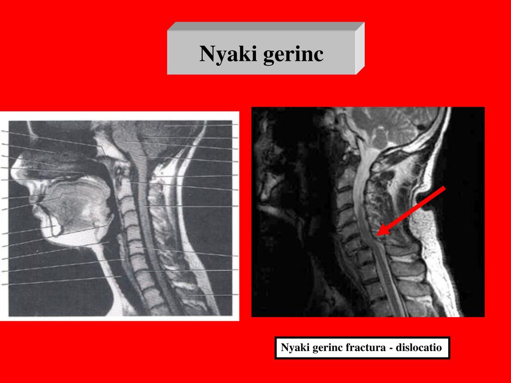 Fájdalom a gerinc ízületében - A nyaki chondroxid kenőcsének osteochondrosis
